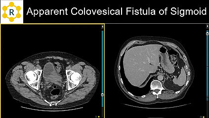 Case 25: CT Abdomen - Colovesical Fistual